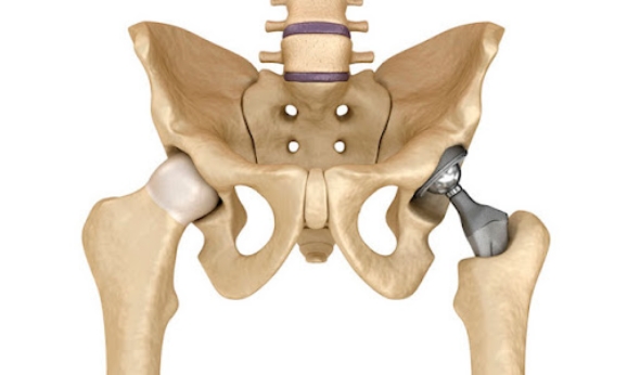 protesis-de-cadera